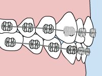 loose bracket - Orthodontics Poway