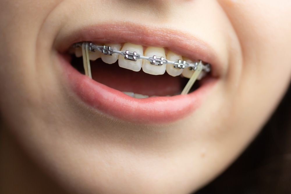 Closeup,Of,A,Woman,With,Braces,Wearing,Power,Chains,And