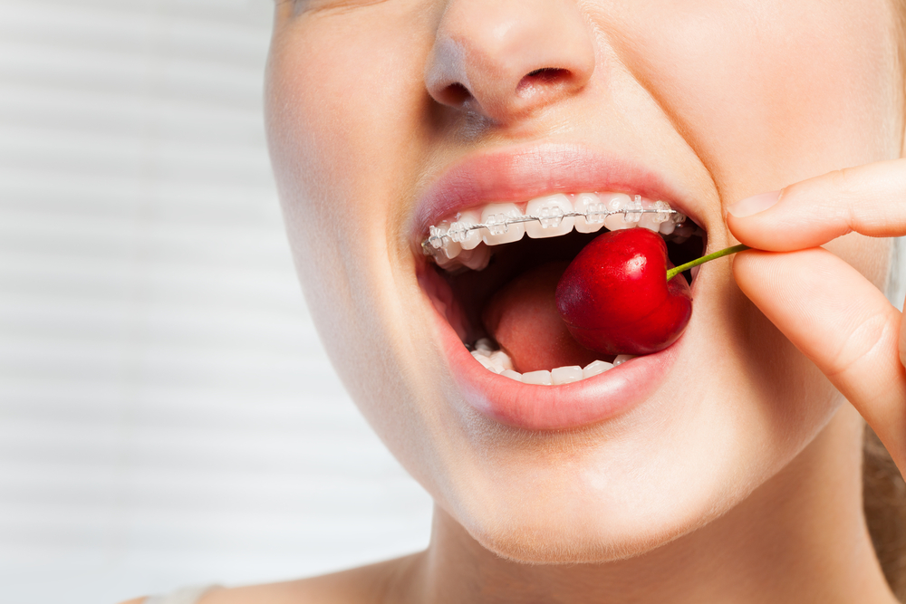 Woman,With,Dental,Brackets,Biting,Off,Red,Cherry